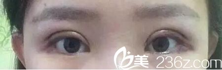 在長春圣顏做雙眼皮手術第三天