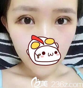 在長春圣顏做雙眼皮手術后4天