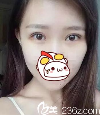 在長春圣顏做雙眼皮手術后5天