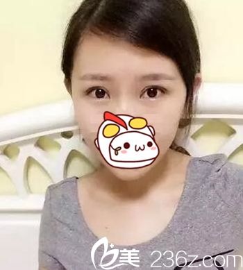 在長春圣顏做雙眼皮手術后11天