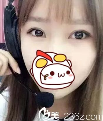 在長春圣顏做雙眼皮手術后40天