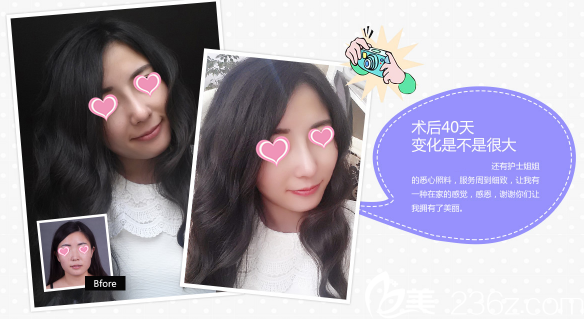 高玉偉主任隆鼻案例 高玉偉主任隆鼻案例