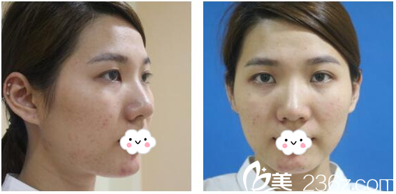 來深圳美萊做雙眼皮前的照片 來深圳美萊做雙眼皮前的照片