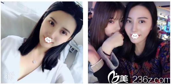 找徐占鋒醫(yī)生割雙眼皮40天恢復(fù)情況 找徐占鋒醫(yī)生割雙眼皮40天恢復(fù)情況