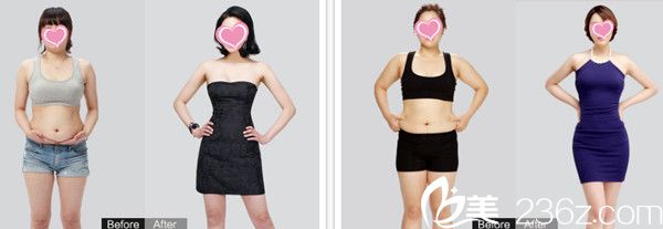 <!--<i data=20240703-sp></i>-->主任吸脂瘦身案例 <!--<i data=20240703-sp></i>-->主任吸脂瘦身案例