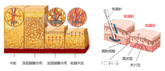 分層吸脂緊膚術(shù)原理 分層吸脂緊膚術(shù)原理