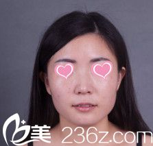 做鼻綜合整形前鼻子塌平 做鼻綜合整形前鼻子塌平