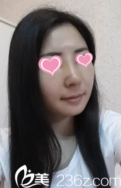 做鼻綜合整形7天拆線后的樣子 做鼻綜合整形7天拆線后的樣子