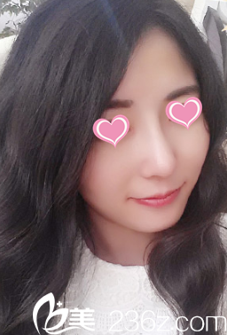 20天自然美鼻效果秀出來 只因在邢臺博愛采用射極峰膨體做鼻綜合整形太靠譜