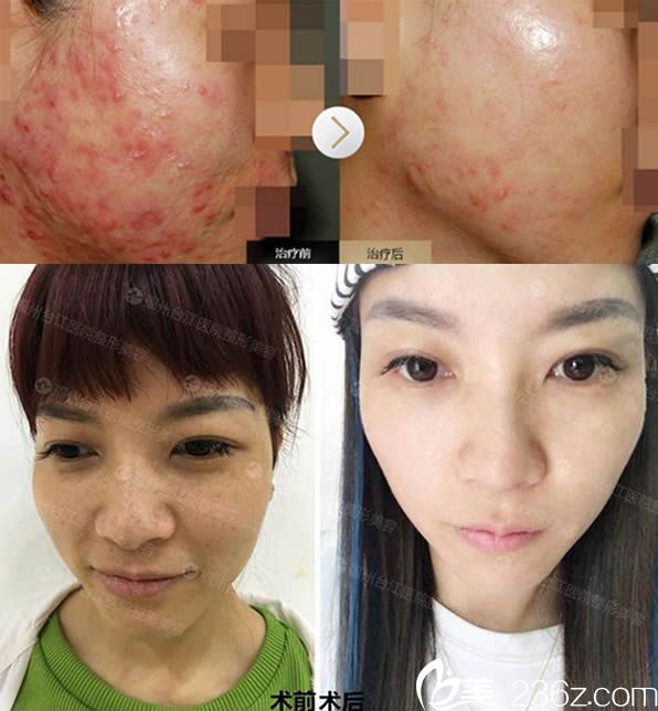 臧劍芳祛痘和激光祛雀斑案例 臧劍芳祛痘和激光祛雀斑案例
