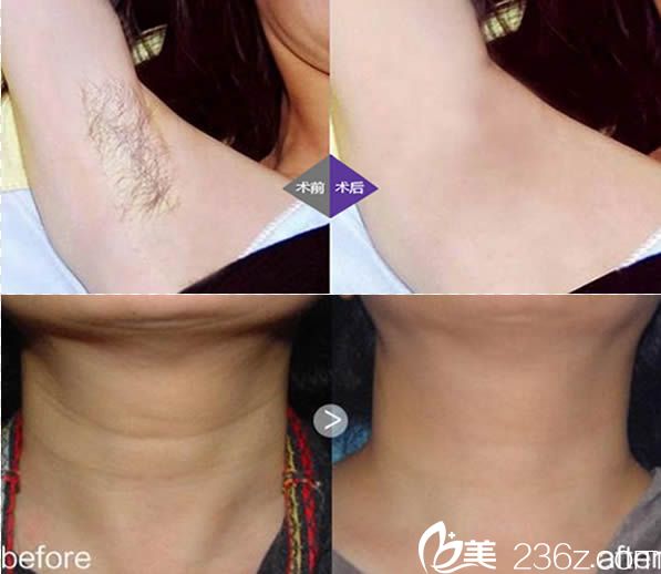 福州臺(tái)江潘桂蘭激光脫毛和祛頸紋案例 福州臺(tái)江潘桂蘭激光脫毛和祛頸紋案例