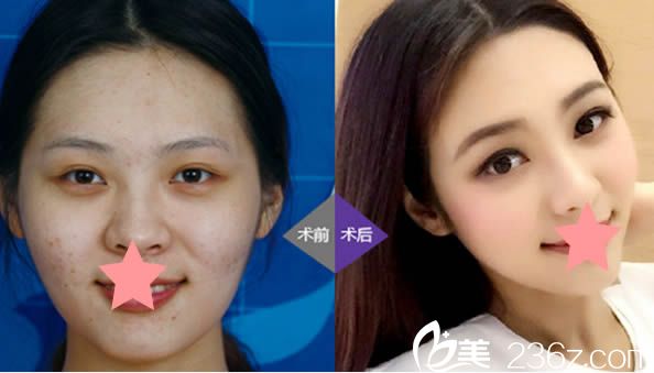 福州臺江虞守輝面部輪廓塑形案例