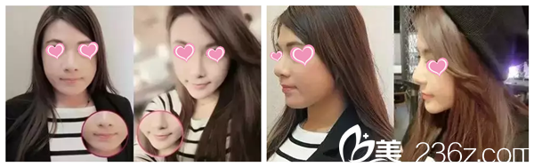 秦秀仙醫(yī)生注射自體脂肪案例