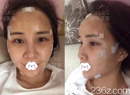 在深圳美萊做完脂肪填充天