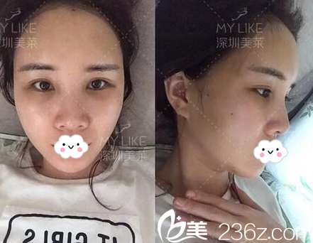 脂肪填充第3天恢復(fù)情況