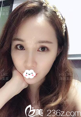 脂肪填充一個(gè)月恢復(fù)情況