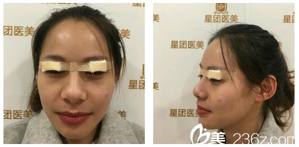 在廣州星團(原博美)做完雙眼皮第2天 在廣州星團(原博美)做完雙眼皮第2天