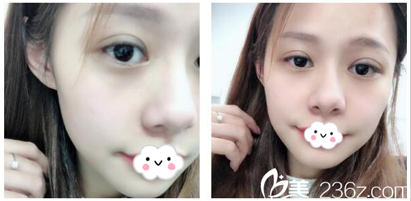 廣州星團(原博美)雙眼皮8天自拍 廣州星團(原博美)雙眼皮8天自拍