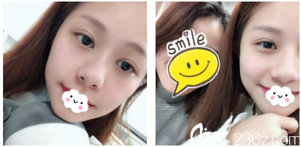 找吳偉航醫(yī)生做雙眼皮已經(jīng)半個月了 找吳偉航醫(yī)生做雙眼皮已經(jīng)半個月了