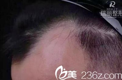 黑龍江瑞麗植發(fā)案例