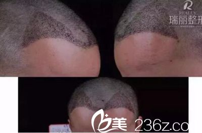 瑞麗植發(fā)術(shù)后第10天