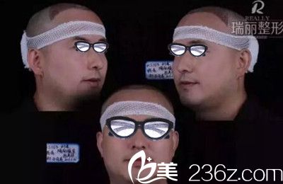 瑞麗植發(fā)術(shù)后即刻效果