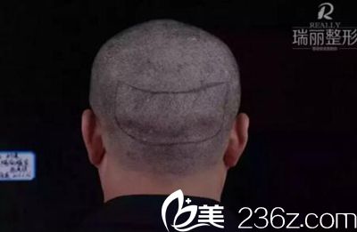 瑞麗植發(fā)取發(fā)區(qū)劃線(xiàn)