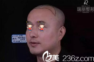 瑞麗植發(fā)術(shù)前左側(cè)頭部劃線(xiàn)