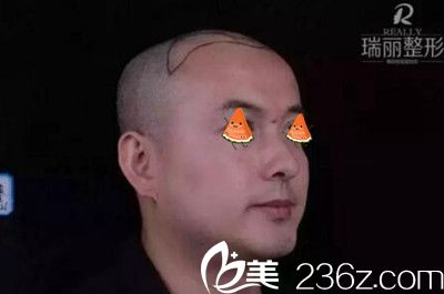 瑞麗植發(fā)術(shù)前右側(cè)頭部劃線(xiàn)