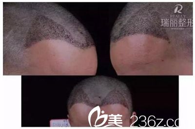 瑞麗植發(fā)術(shù)后第5天