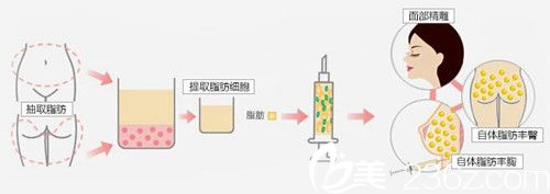 韓國(guó)必當(dāng)歸整形醫(yī)院自體脂肪填充 韓國(guó)必當(dāng)歸整形醫(yī)院自體脂肪填充