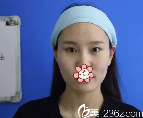 遵義韓美于建濤做全切雙眼皮+開內(nèi)眼角 遵義韓美于建濤做全切雙眼皮+開內(nèi)眼角