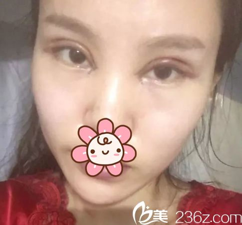 于建濤雙眼皮術(shù)后3天 于建濤雙眼皮術(shù)后3天