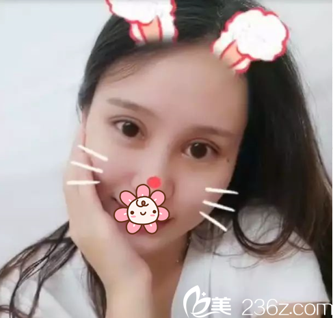 遵義雙眼皮手術(shù)后15天 遵義雙眼皮手術(shù)后15天