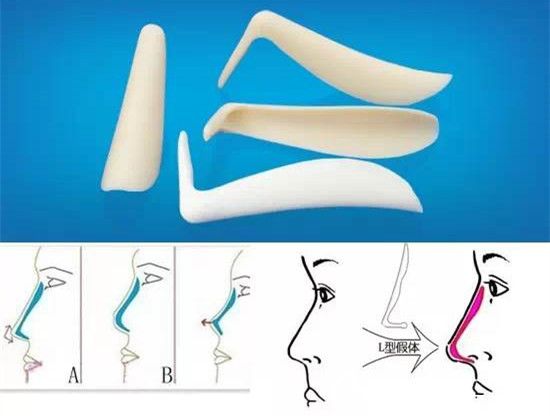 單純L型假體隆鼻