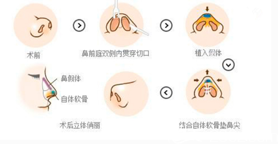 加耳軟骨墊鼻尖的復合假體隆鼻