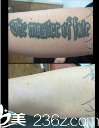 喬顏思祛除紋身案例對(duì)比效果