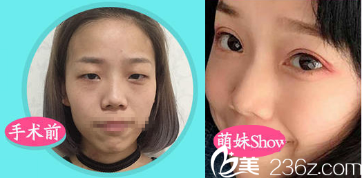 成都軍建整形<!--<i data=20240703-sp></i>-->雙眼皮案例