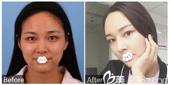 <!--<i data=20240703-sp></i>--><!--<i data=20240703-sp></i>-->鼻綜合隆鼻案例前后對比圖 <!--<i data=20240703-sp></i>--><!--<i data=20240703-sp></i>-->鼻綜合隆鼻案例前后對比圖