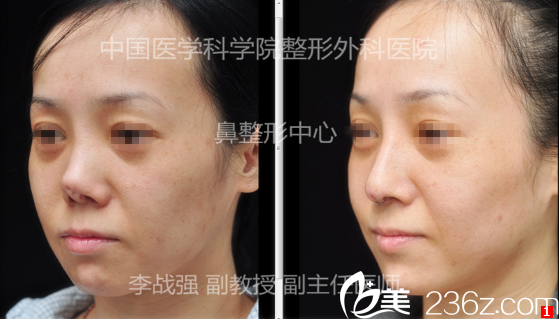 <!--<i data=20240703-sp></i>--><!--<i data=20240703-sp></i>-->假體隆鼻失敗修復(fù)案例 <!--<i data=20240703-sp></i>--><!--<i data=20240703-sp></i>-->假體隆鼻失敗修復(fù)案例