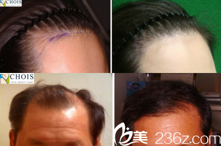 崔院長(zhǎng)毛發(fā)移植真人案例效果對(duì)比