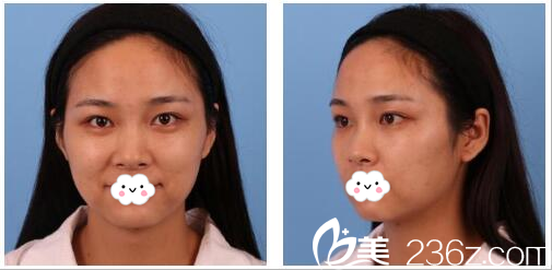 找<!--<i data=20240703-sp></i>-->做隆鼻術(shù)前照片 找<!--<i data=20240703-sp></i>-->做隆鼻術(shù)前照片