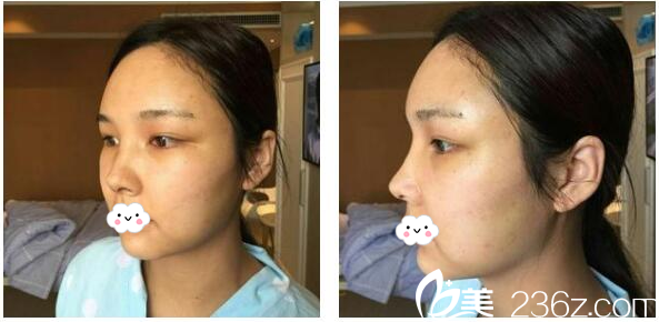 <!--<i data=20240703-sp></i>-->給我做的鼻綜合隆鼻第8天自拍 <!--<i data=20240703-sp></i>-->給我做的鼻綜合隆鼻第8天自拍