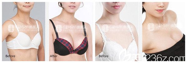 張寶成院長(zhǎng)隆胸案例