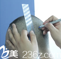 發(fā)際線移植前檢查準(zhǔn)備