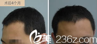 術(shù)后4個月頭發(fā)情況