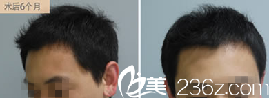 直擊—80后小伙在韓國(guó)喬顏思美容醫(yī)院親述毛發(fā)再生過(guò)程感受