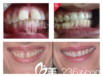 武興肖院長正畸矯正案例