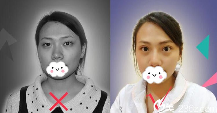 求職受挫到找主任做雙眼皮+鼻綜合重獲