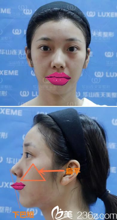 注射玻尿酸填充前的正面和側(cè)面照 注射玻尿酸填充前的正面和側(cè)面照